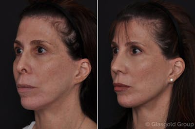 Upper Eyelid Before & After Gallery - Patient 266494 - Image 1