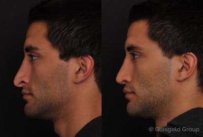 Revision Rhinoplasty Before & After Gallery - Patient 349643 - Image 1