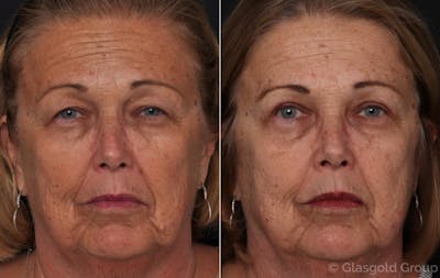 Upper Eyelid Before & After Gallery - Patient 367600 - Image 1