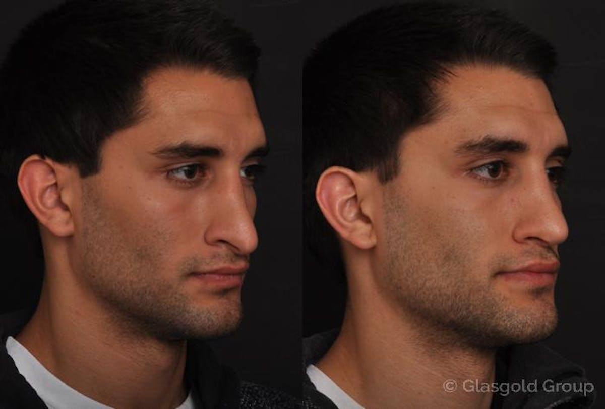 Revision Rhinoplasty Before & After Gallery - Patient 349643 - Image 3