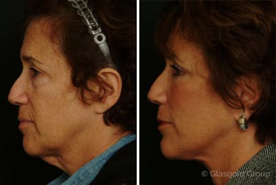 Facelift Before & After Gallery - Patient 321398 - Image 1