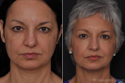 Upper Eyelid Before & After Gallery - Patient 270439 - Image 1