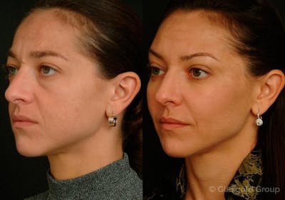 Fat Transfer Before & After Gallery - Patient 103017 - Image 1