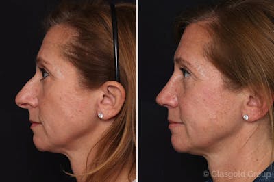 Rhinoplasty Before & After Gallery - Patient 597035 - Image 1