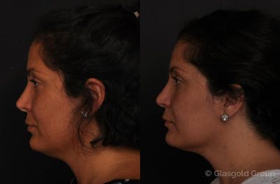 Revision Rhinoplasty Before & After Gallery - Patient 145727 - Image 1