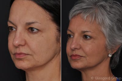 Upper Eyelid Before & After Gallery - Patient 270439 - Image 1