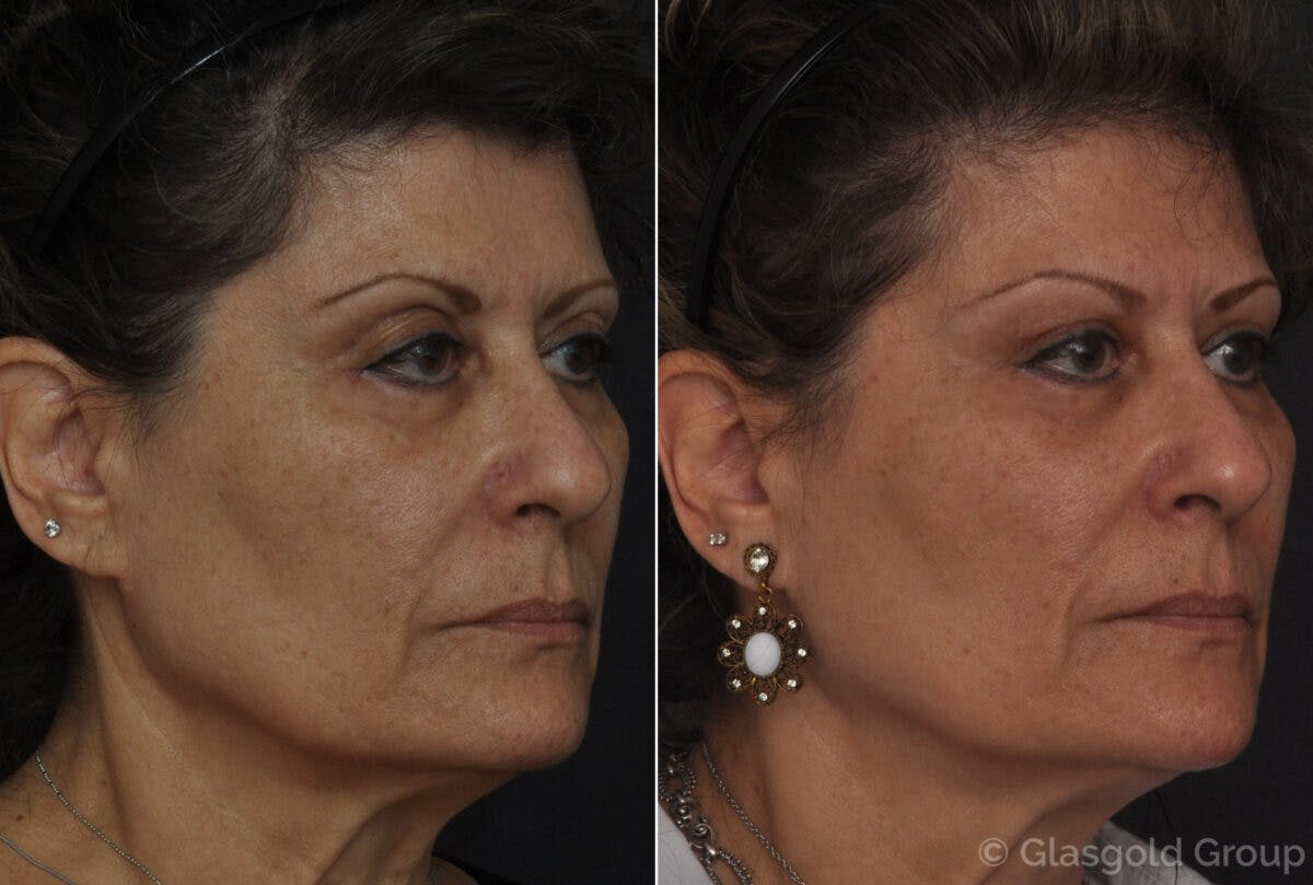 Fat Transfer Before & After Gallery - Patient 353309 - Image 1