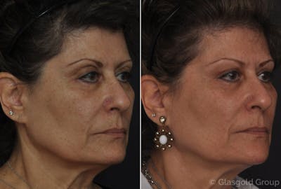 Fat Transfer Before & After Gallery - Patient 353309 - Image 1