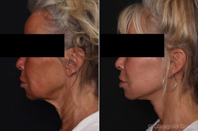 Facelift Before & After Gallery - Patient 343077 - Image 1