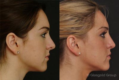 Revision Rhinoplasty Before & After Gallery - Patient 279373 - Image 1