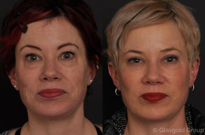 Upper Eyelid Before & After Gallery - Patient 302949 - Image 1