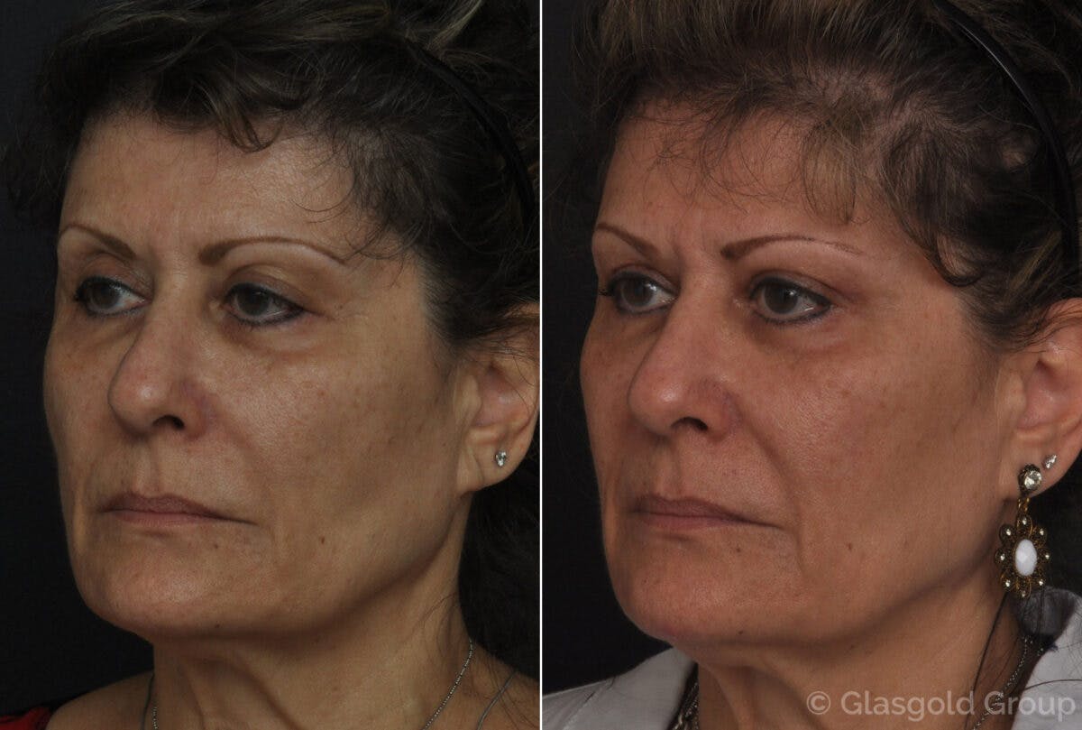 Fat Transfer Before & After Gallery - Patient 353309 - Image 3
