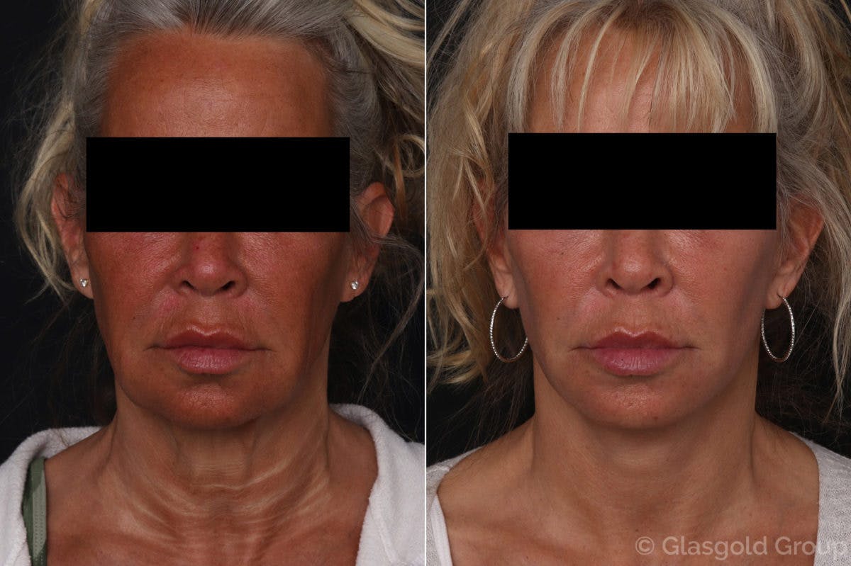 Facelift Before & After Gallery - Patient 343077 - Image 3