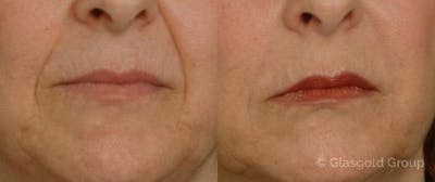 Nasolabial Fold (Smile Lines) Before & After Gallery - Patient 358682 - Image 1