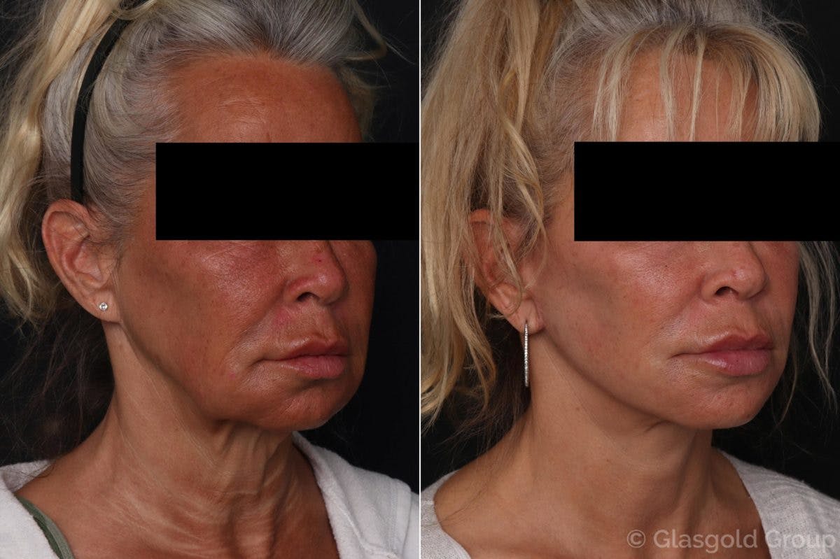 Facelift Before & After Gallery - Patient 343077 - Image 1