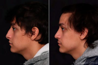 Rhinoplasty Before & After Gallery - Patient 289001 - Image 1