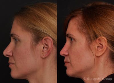 Revision Rhinoplasty Before & After Gallery - Patient 377887 - Image 1