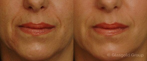 Nasolabial Fold (Smile Lines) Before & After Gallery - Patient 383468 - Image 2