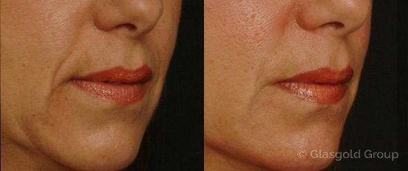 Nasolabial Fold (Smile Lines) Before & After Gallery - Patient 383468 - Image 3