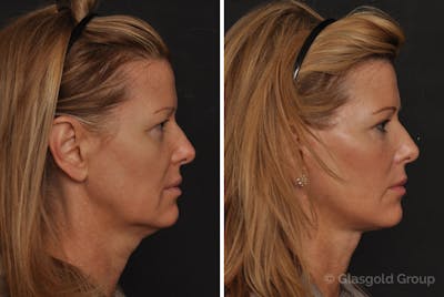 Facelift Before & After Gallery - Patient 861574 - Image 1