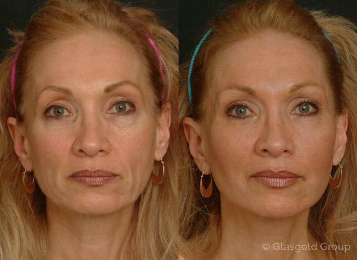 Fat Transfer Before & After Gallery - Patient 959420 - Image 3