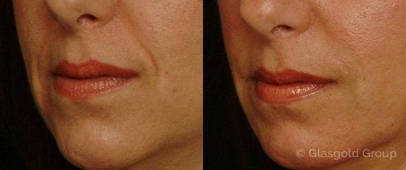 Nasolabial Fold (Smile Lines) Before & After Gallery - Patient 383468 - Image 1