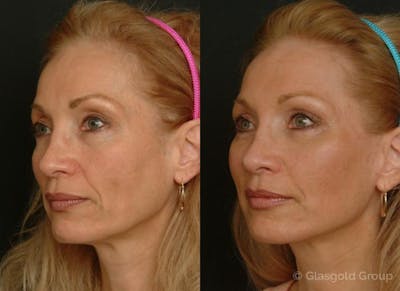 Fat Transfer Before & After Gallery - Patient 959420 - Image 1