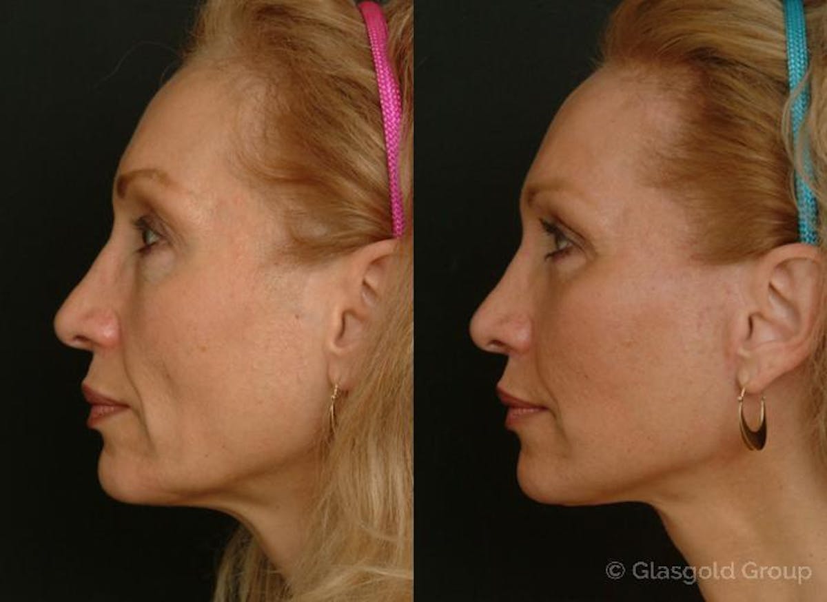 Fat Transfer Before & After Gallery - Patient 959420 - Image 1