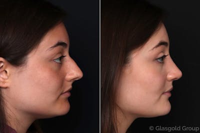 Rhinoplasty Before & After Gallery - Patient 353686 - Image 1