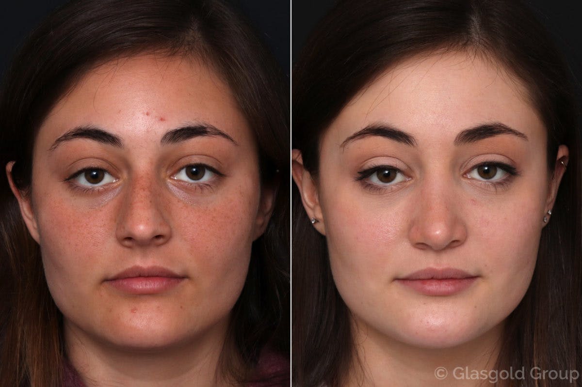 Rhinoplasty Before & After Gallery - Patient 353686 - Image 2