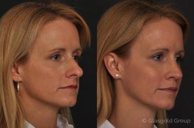 Fat Transfer Before & After Gallery - Patient 907930 - Image 1