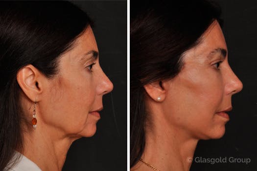 Facelift Before & After Gallery - Patient 342655 - Image 1