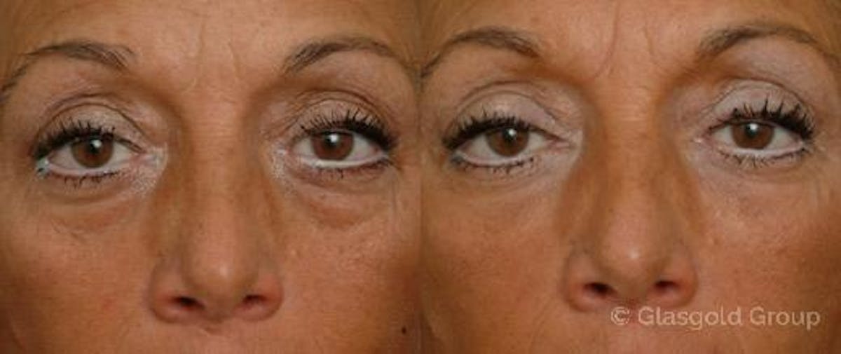 Lower Eyelid-Midface Before & After Gallery - Patient 947317 - Image 1