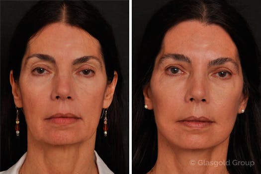 Facelift Before & After Gallery - Patient 342655 - Image 3