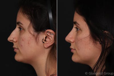 Rhinoplasty Before & After Gallery - Patient 811980 - Image 1