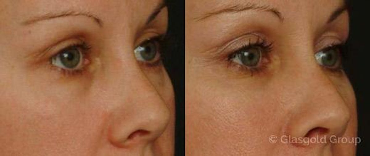 Lower Eyelid-Midface Before & After Gallery - Patient 169713 - Image 1
