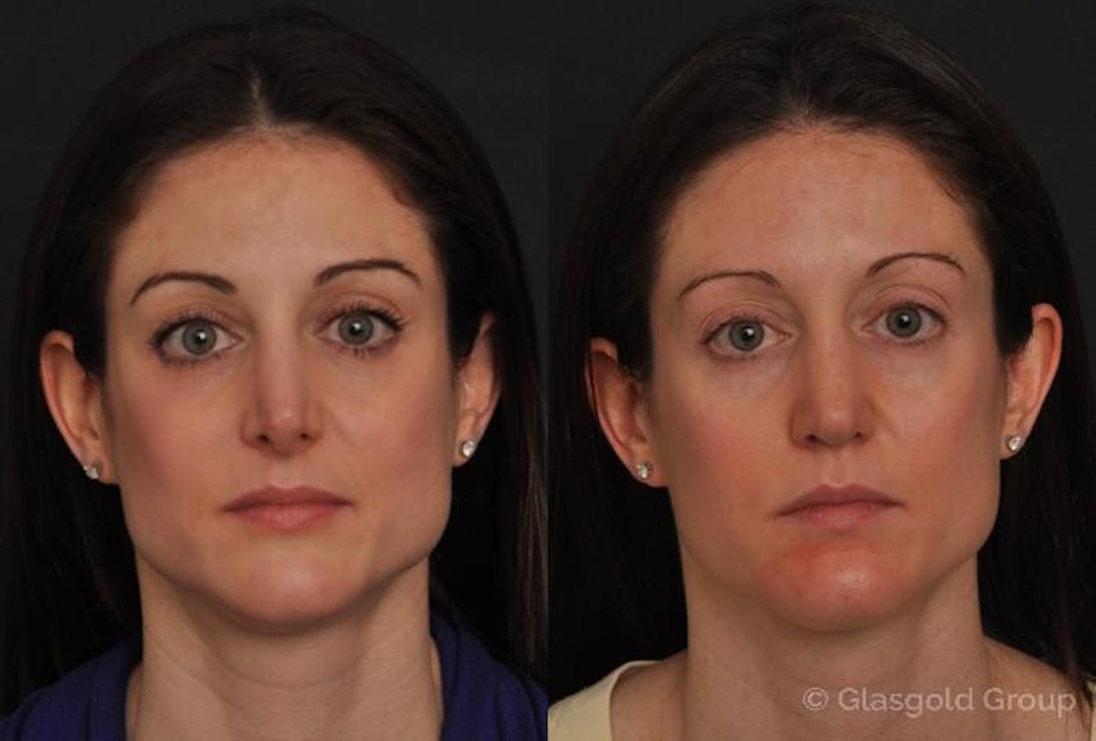 Revision Rhinoplasty Before & After Gallery - Patient 199335 - Image 2