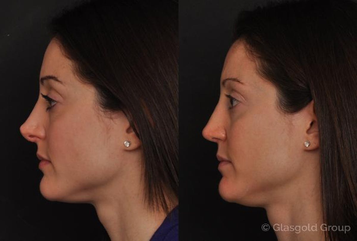 Revision Rhinoplasty Before & After Gallery - Patient 199335 - Image 1