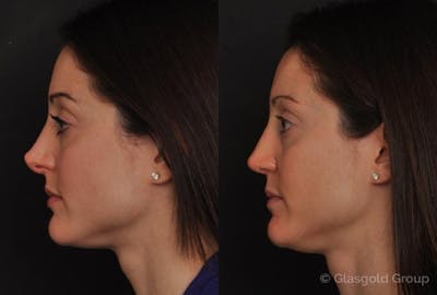 Revision Rhinoplasty Before & After Gallery - Patient 199335 - Image 1