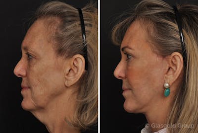 Facelift Before & After Gallery - Patient 214035 - Image 1
