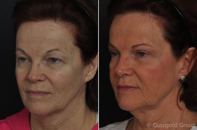 Fat Transfer Before & After Gallery - Patient 367505 - Image 1