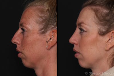 Rhinoplasty Before & After Gallery - Patient 312563 - Image 1