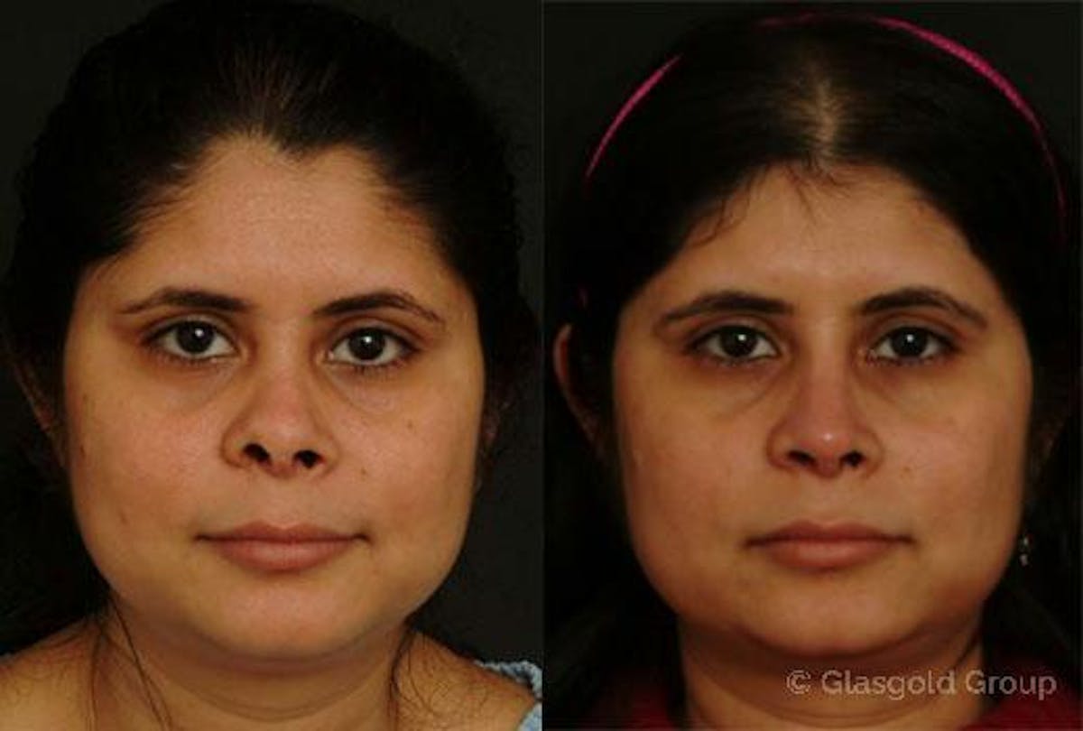 Revision Rhinoplasty Before & After Gallery - Patient 248175 - Image 2