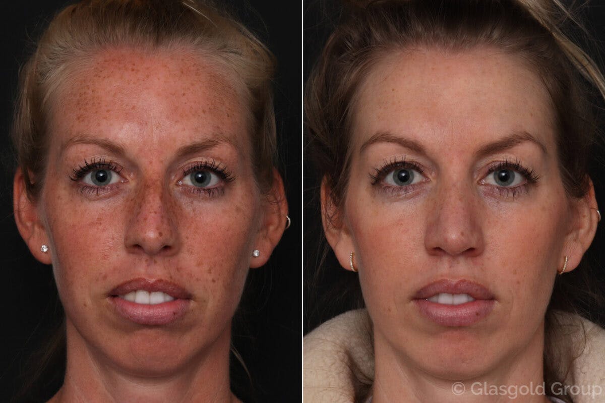 Rhinoplasty Before & After Gallery - Patient 312563 - Image 2