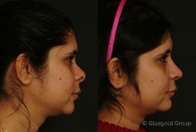 Revision Rhinoplasty Before & After Gallery - Patient 248175 - Image 1