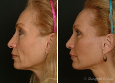 Facelift Before & After Gallery - Patient 302604 - Image 1