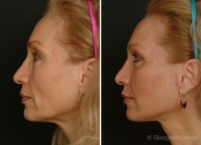 Facelift Before & After Gallery - Patient 302604 - Image 1