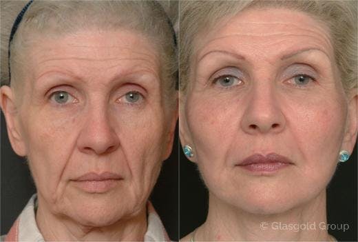 Fat Transfer Before & After Gallery - Patient 233464 - Image 2