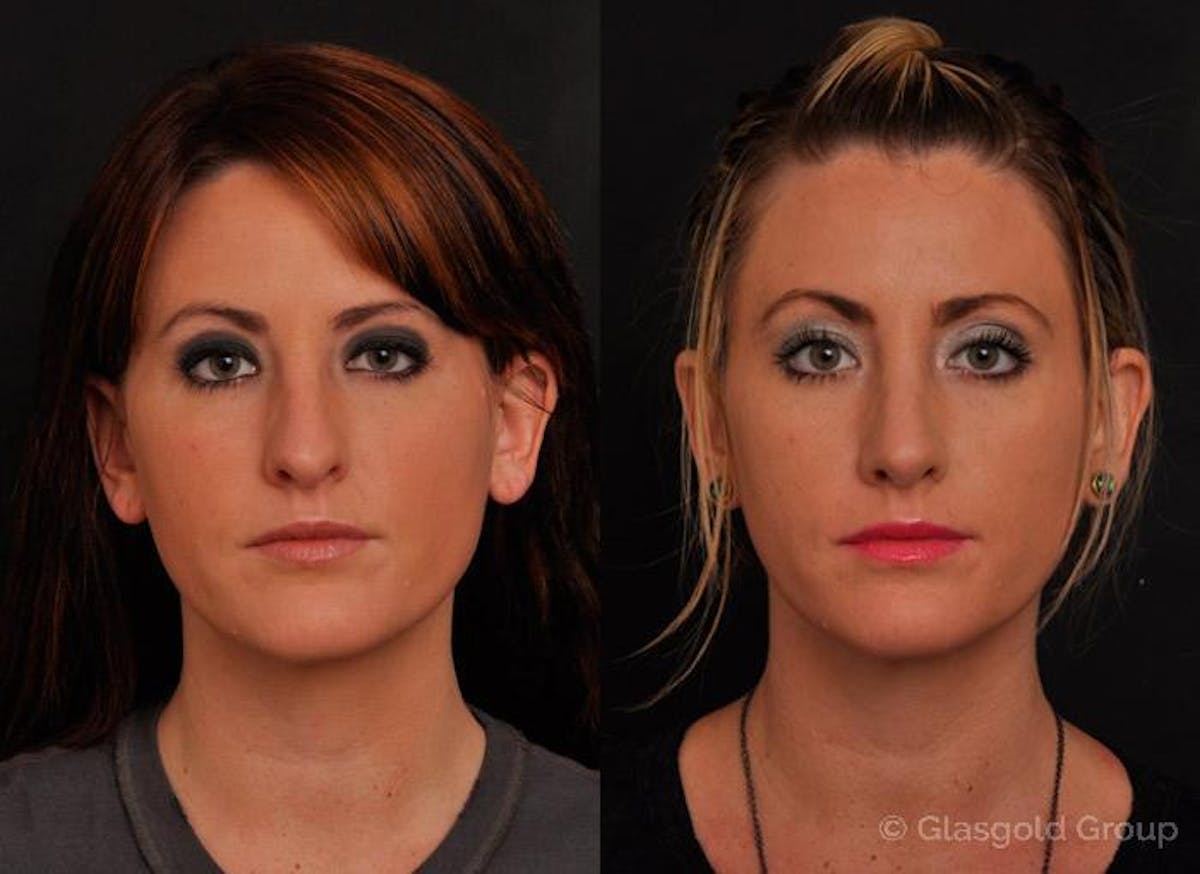 Revision Rhinoplasty Before & After Gallery - Patient 137317 - Image 2