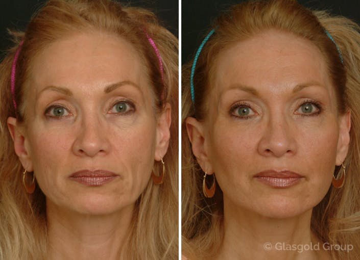 Facelift Before & After Gallery - Patient 302604 - Image 4
